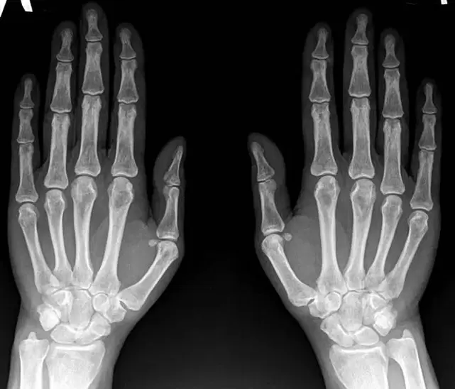 Arthritis des Handgelenks im Röntgenbild vor der Anwendung von Hondroine