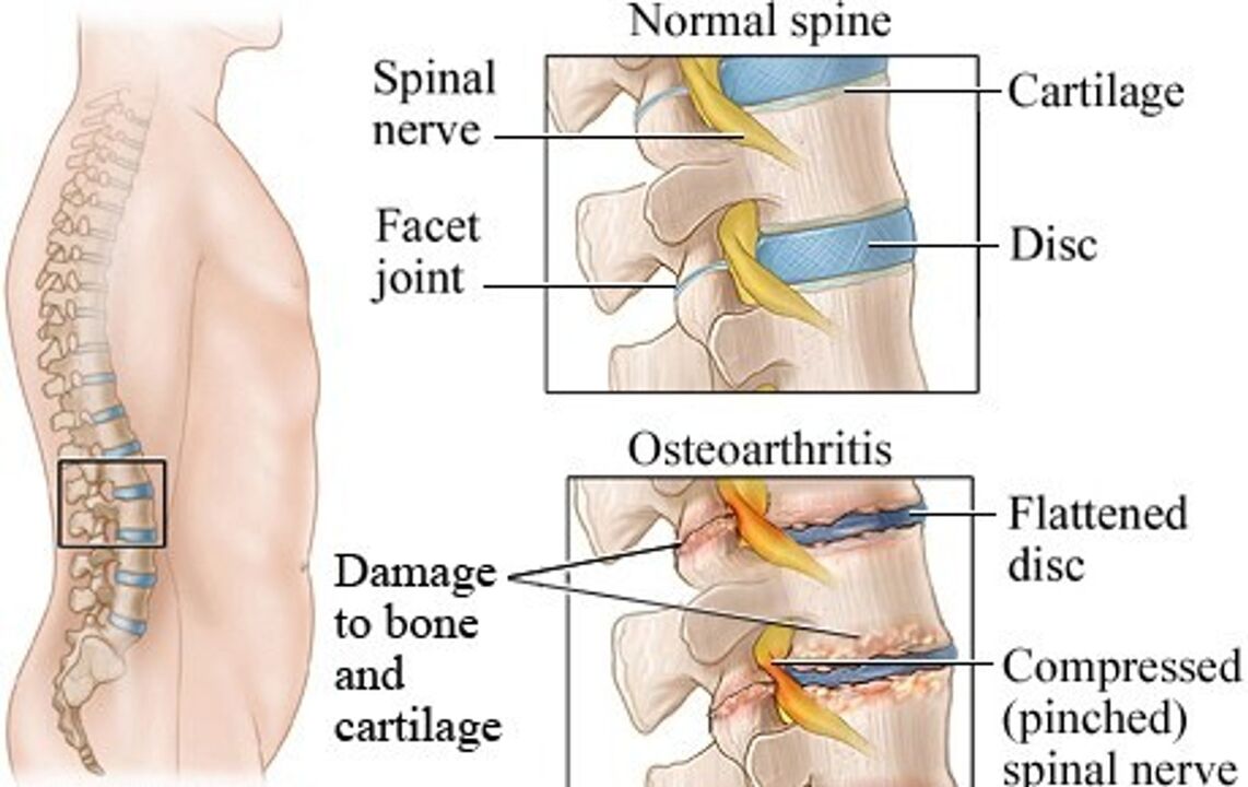 Der Unterschied zwischen einer gesunden Scheibe und einer Scheibe mit Osteochondrose