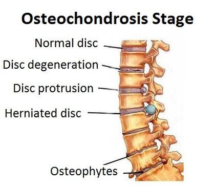 Stadien der Osteochondrose