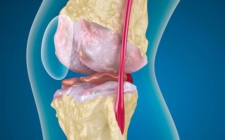 Die Gründe für die Entwicklung der Arthrose des Kniegelenks