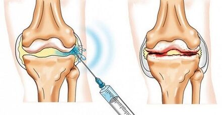 wie man Arthrose des Kniegelenks behandelt